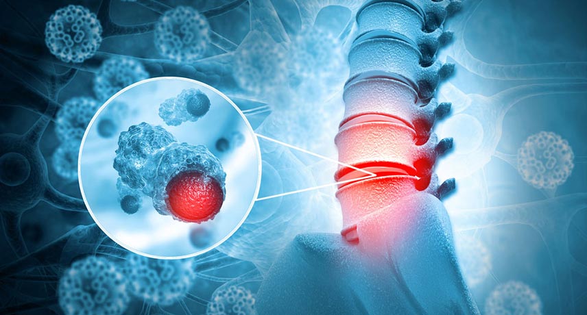 conheca os principais tipos de tumores na medula espinhal