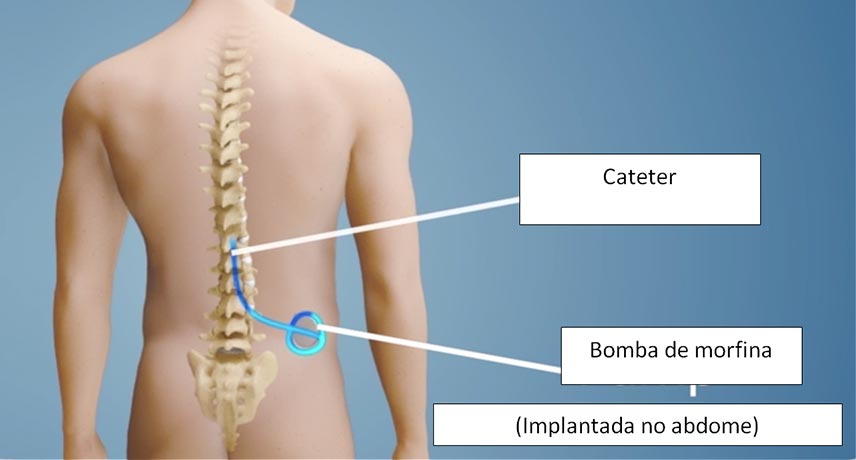 funcionamento e beneficios da bomba de morfina no controle da dor